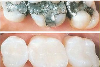 dentalfilling