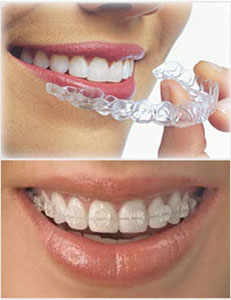 fixedbracess