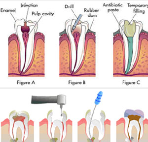 rootcanal