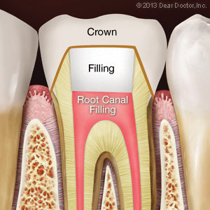 rootcanal1
